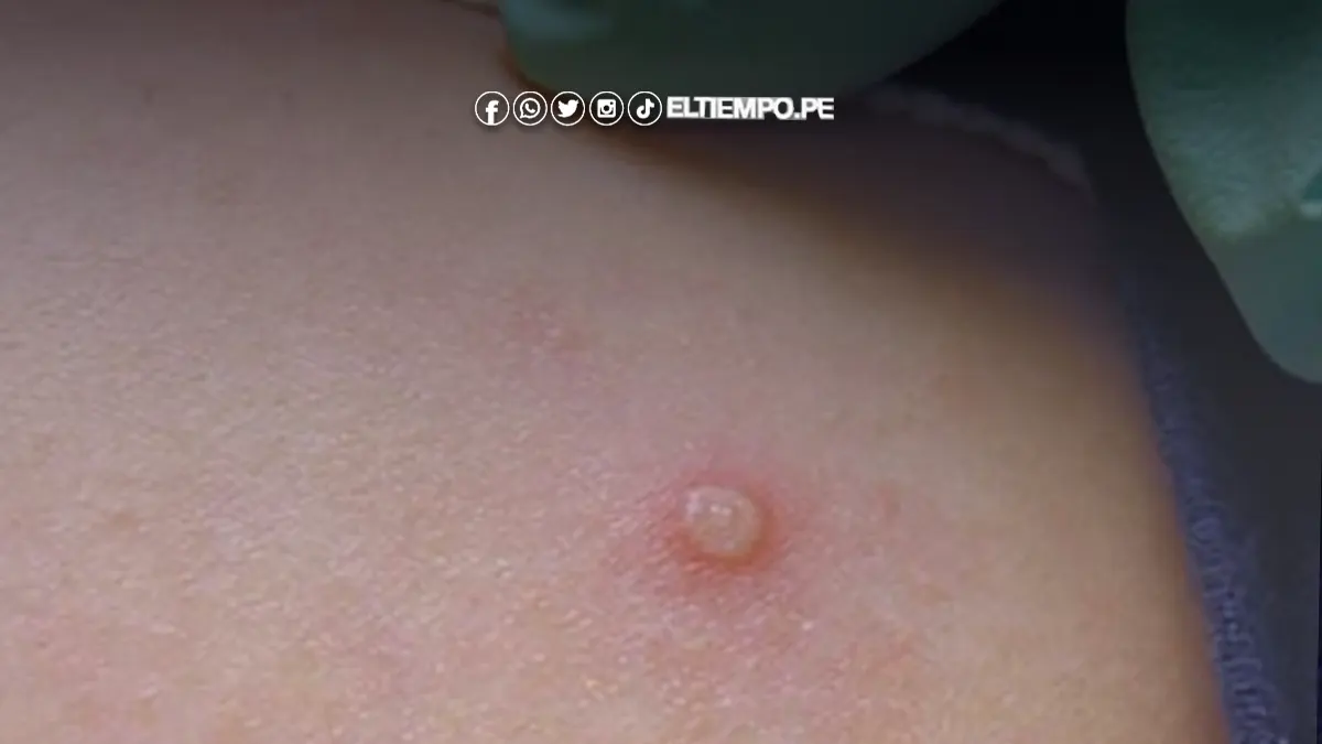 Primer caso de viruela de mono en Huancayo Primer caso de viruela de mono en Huancayo