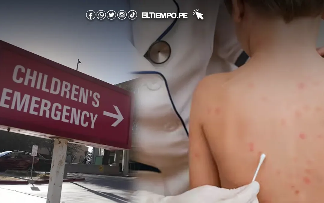 EE.UU: Brote de sarampión deja dos muertos y más de 130 casos