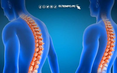 La escoliosis, la enfermedad que si no tratada a tiempo puede generar una discapacidad