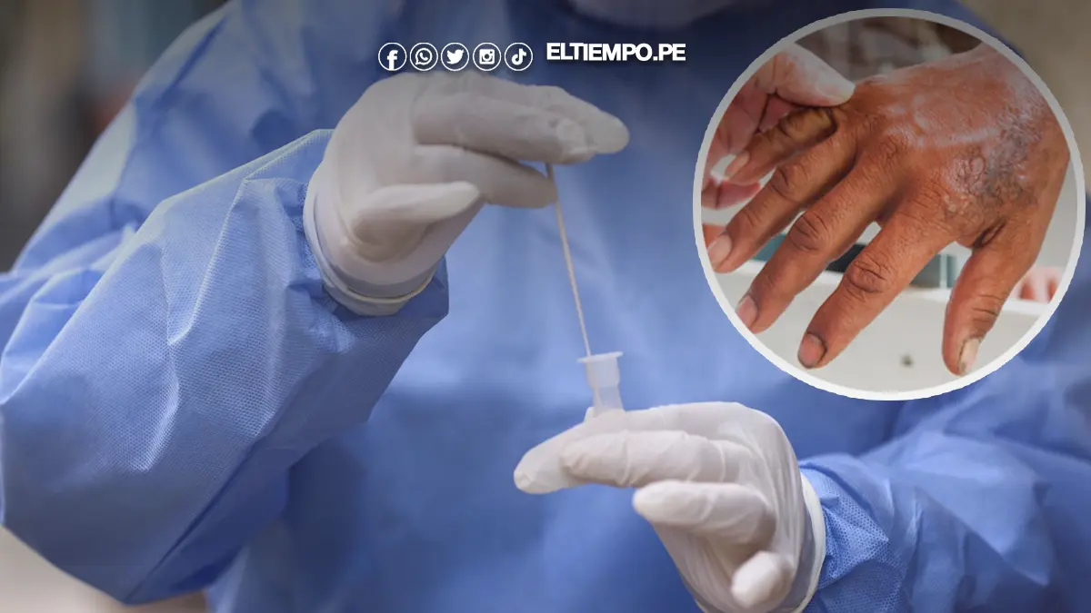 lepra en Piura lepra en Piura