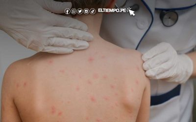 «Los recién nacidos son los más propensos enfermar con sarampión y tos ferina»