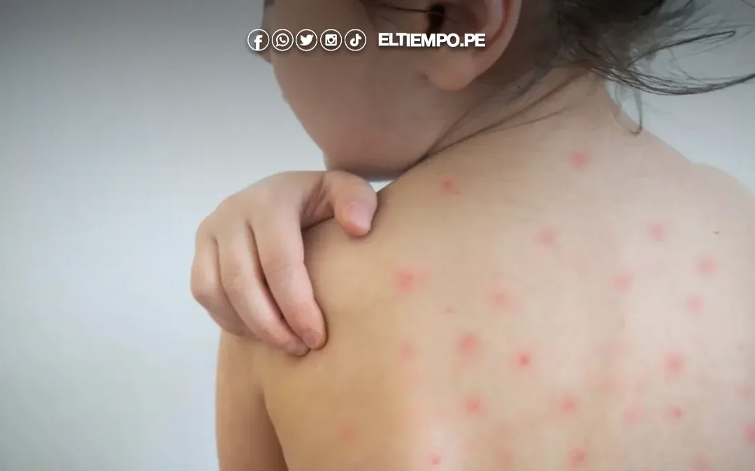 Menos del 40% de los piuranos está vacunado contra la varicela