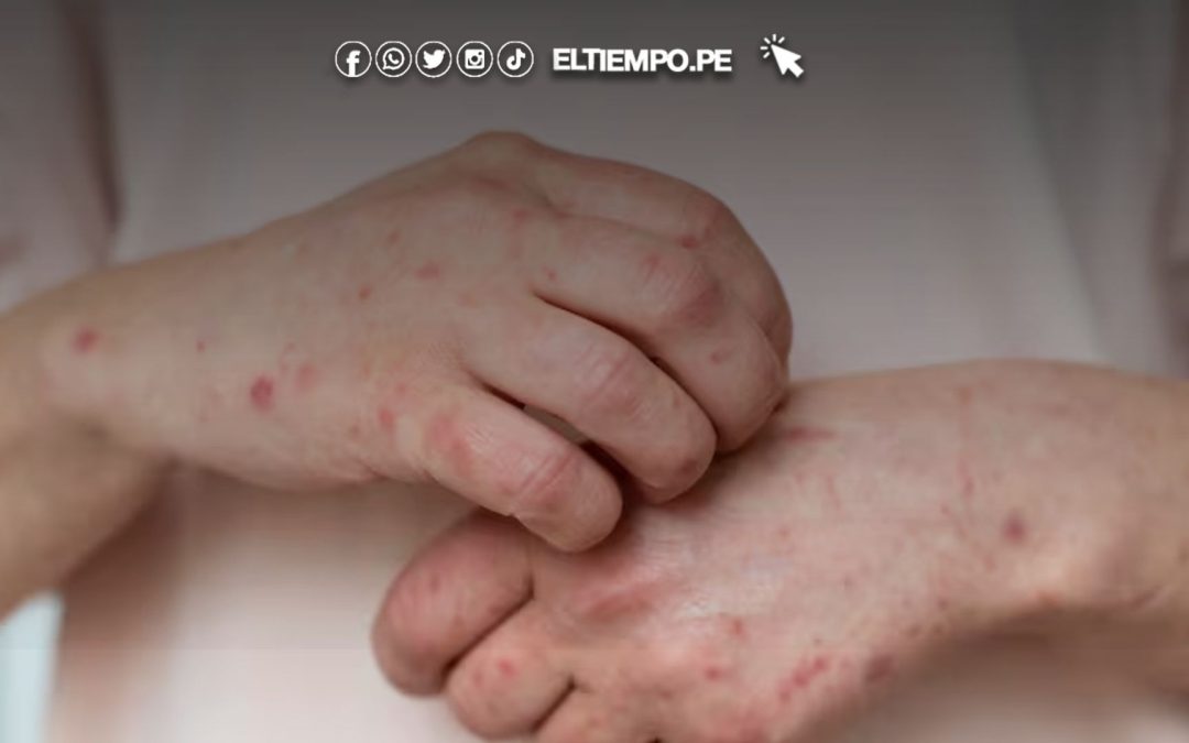 Canadá registra más de 5.100 casos de sarampión en los últimos 12 meses