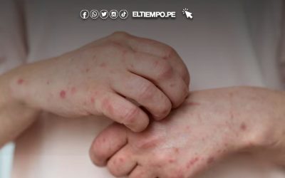 Canadá registra más de 5.100 casos de sarampión en los últimos 12 meses